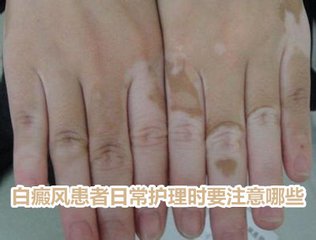 白癜风图片 白癜风症状图片